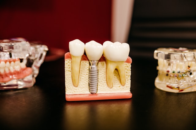 What to Expect When You Get a Dental Crown Procedure