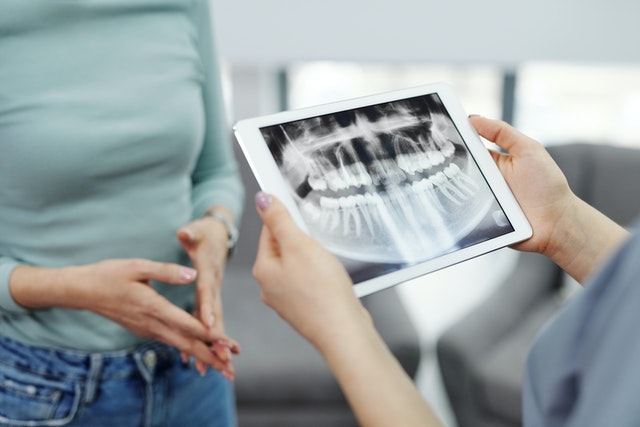 What Are Dental Implants? (Everything You Need to Know)