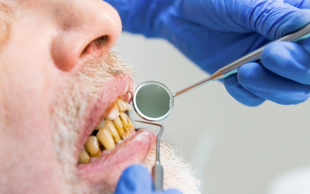 Is There a Way to Reverse Cavities and Tooth Decay?