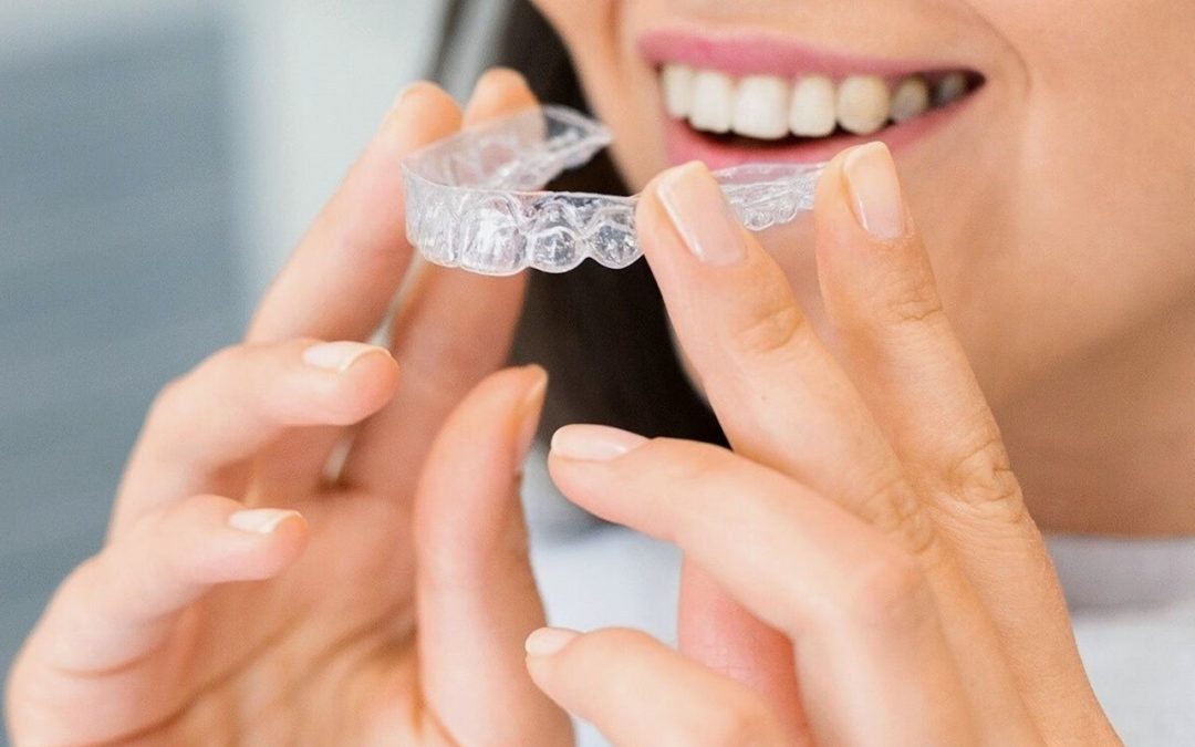 The Perfect Smile: What You Should Know about Invisalign