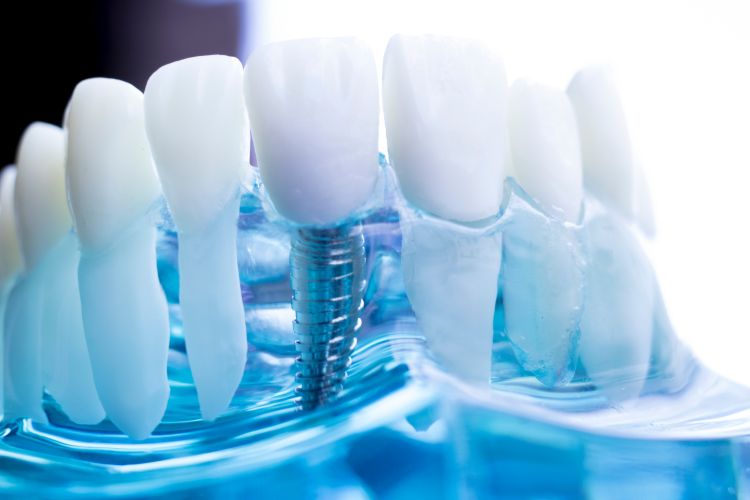 dental implant model