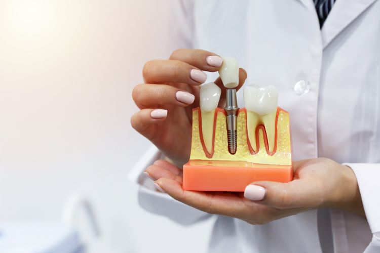 Are You a Candidate for Dental Implants?