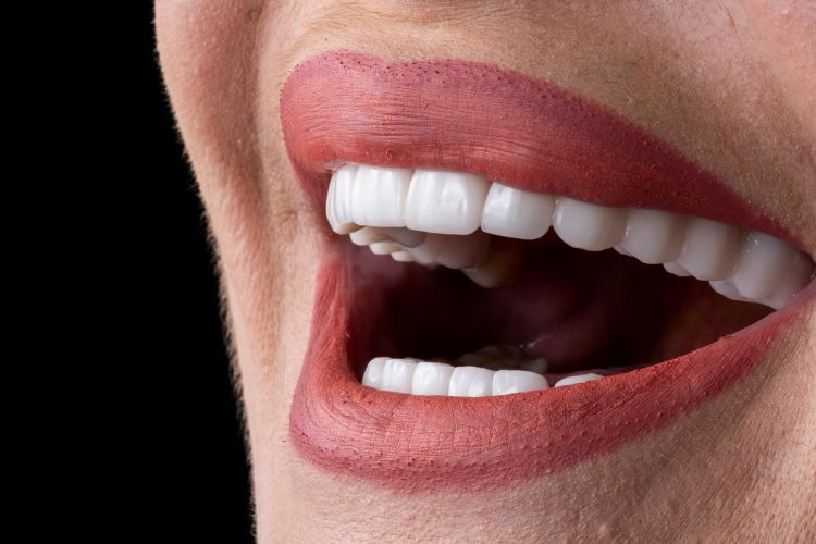 Upgrade Smile with the Best Veneers in Arizona