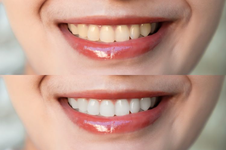 5 Teeth Whitening Mistakes