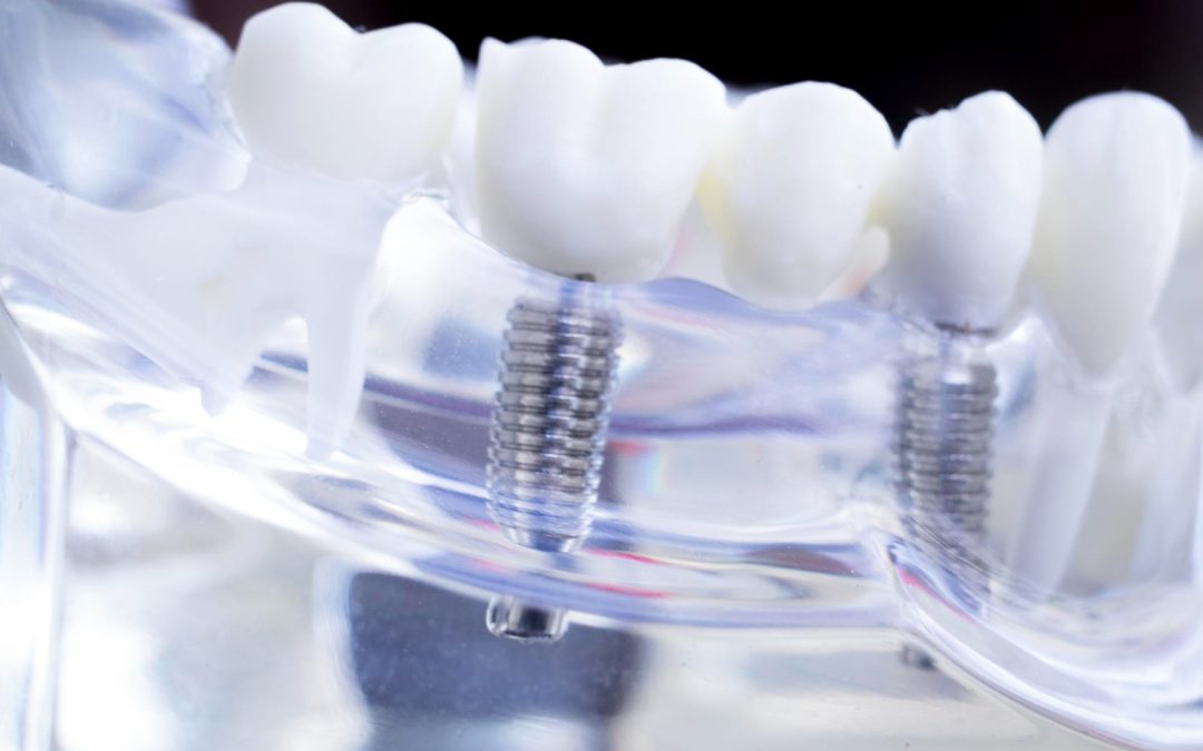 Understanding the Benefits of Fully Digital Dental Implants
