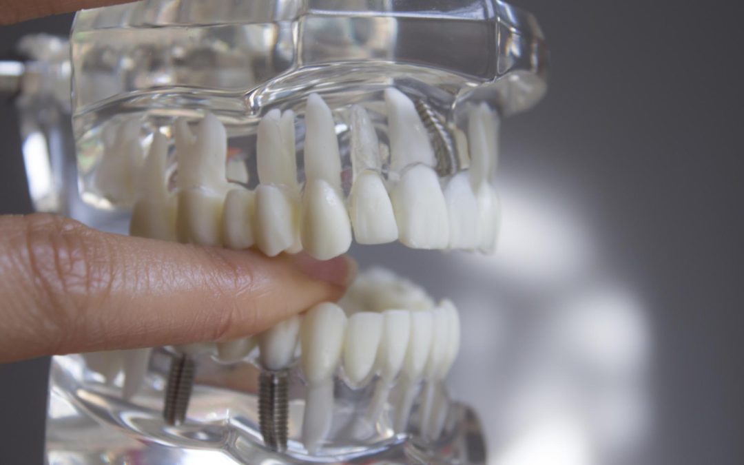 Dental Implants