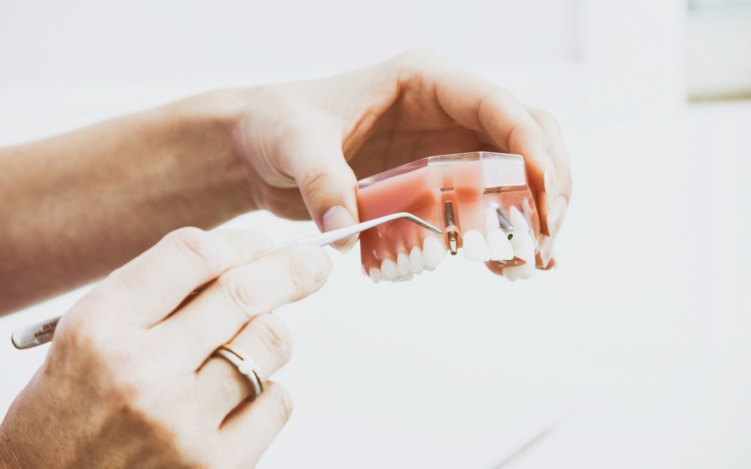 How Dental Implants Can Change Your Life
