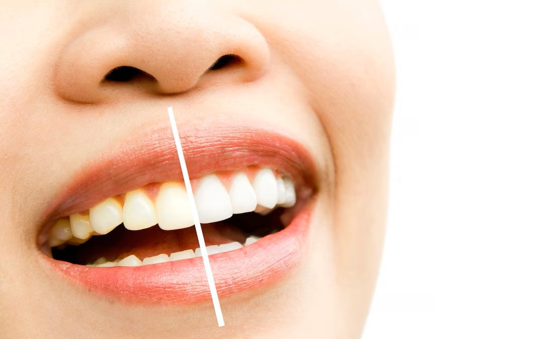 Cosmetic Dental Procedures That Boost Your Confidence