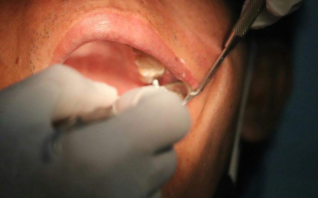 Steps to Take Before and After Wisdom Teeth Removal in Oro Valley