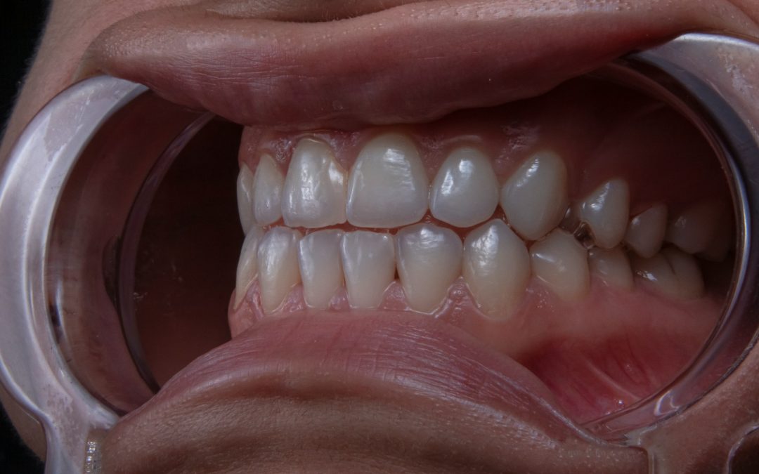 Common Problems with Traditional Veneers and Modern Solutions