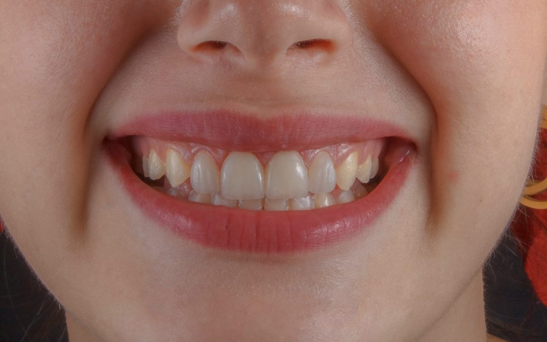 Same-Day Dental Crowns