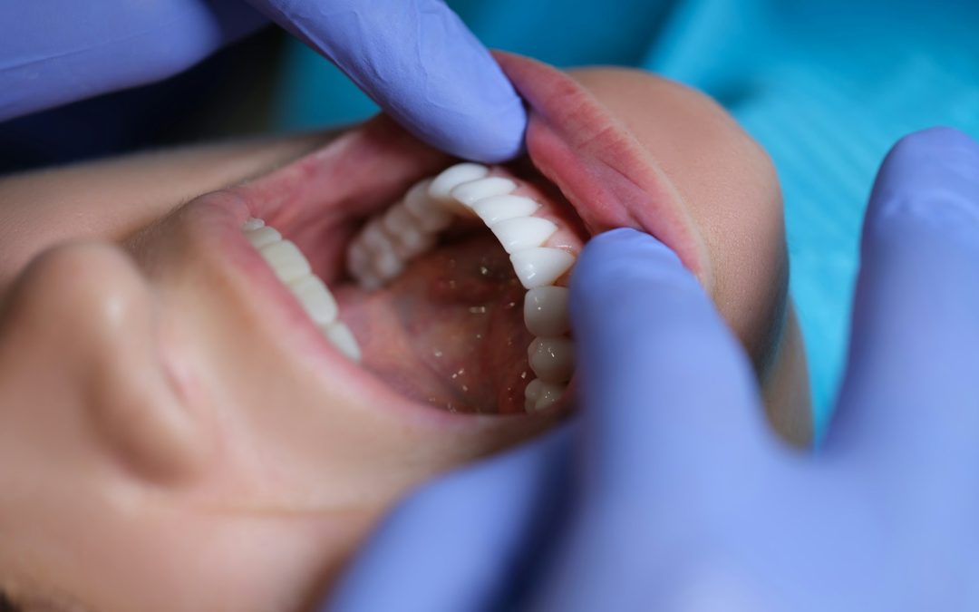 What Makes Lumineers Different from Traditional Veneers